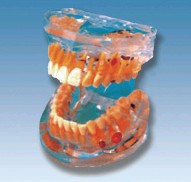 透明牙体病理模型Bk-L1008