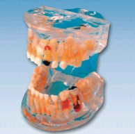 透明乳牙病理模型Bk-L1006