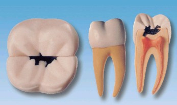 右侧第一颗磨牙蛀牙模型Bk-L1002