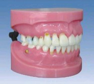 牙周病演示模型Bk-L1022