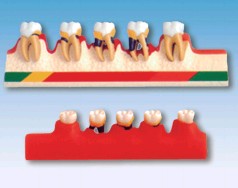 牙周病分类模型