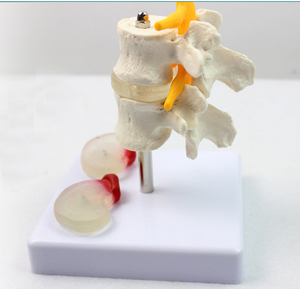 2节腰椎附2个病变椎间盘模型